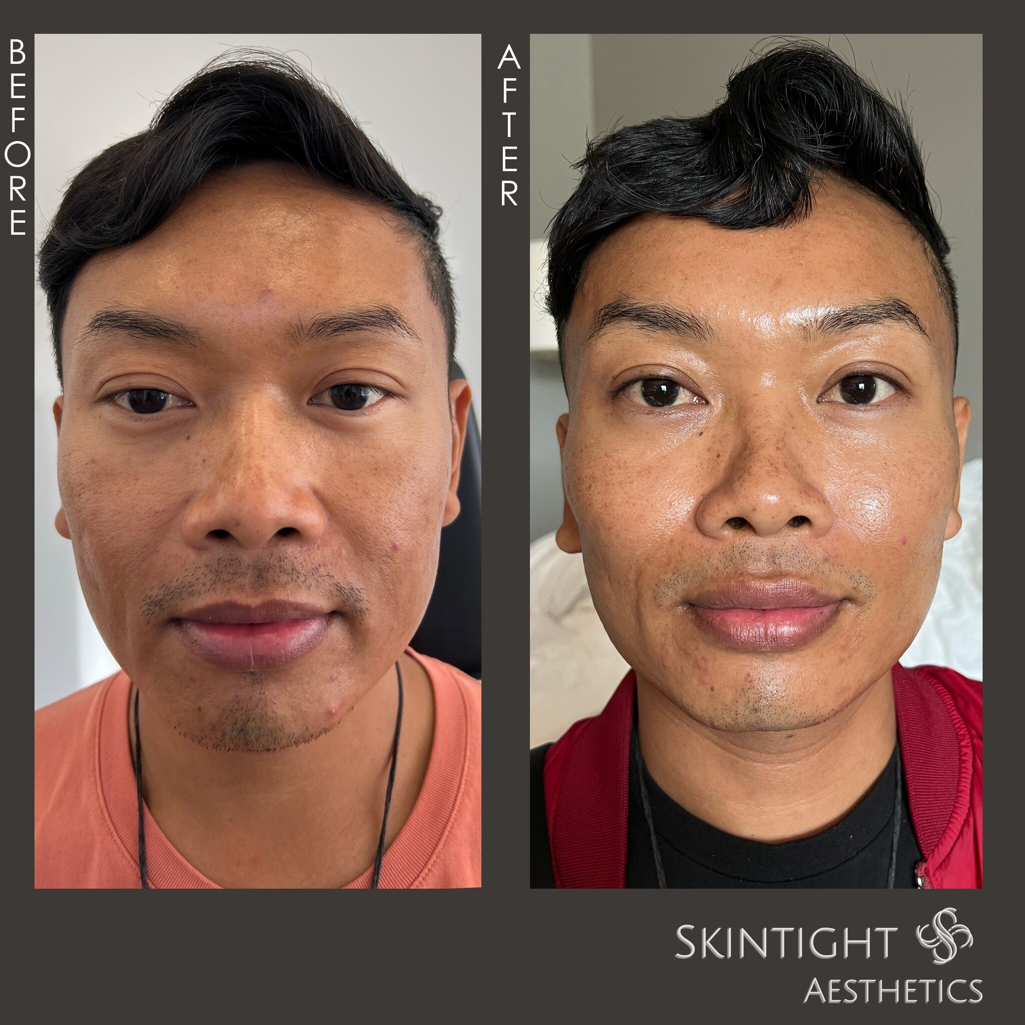 Our RuPaul's Drag Race superstar @jujubeeonline looking ✨REFRESHED ✨

In between a busy travel schedule Jujubee came to visit us to get a little rejuvenation. Using Voluma to the cheeks we were able to reduce the appearance of the nasolabial folds gi