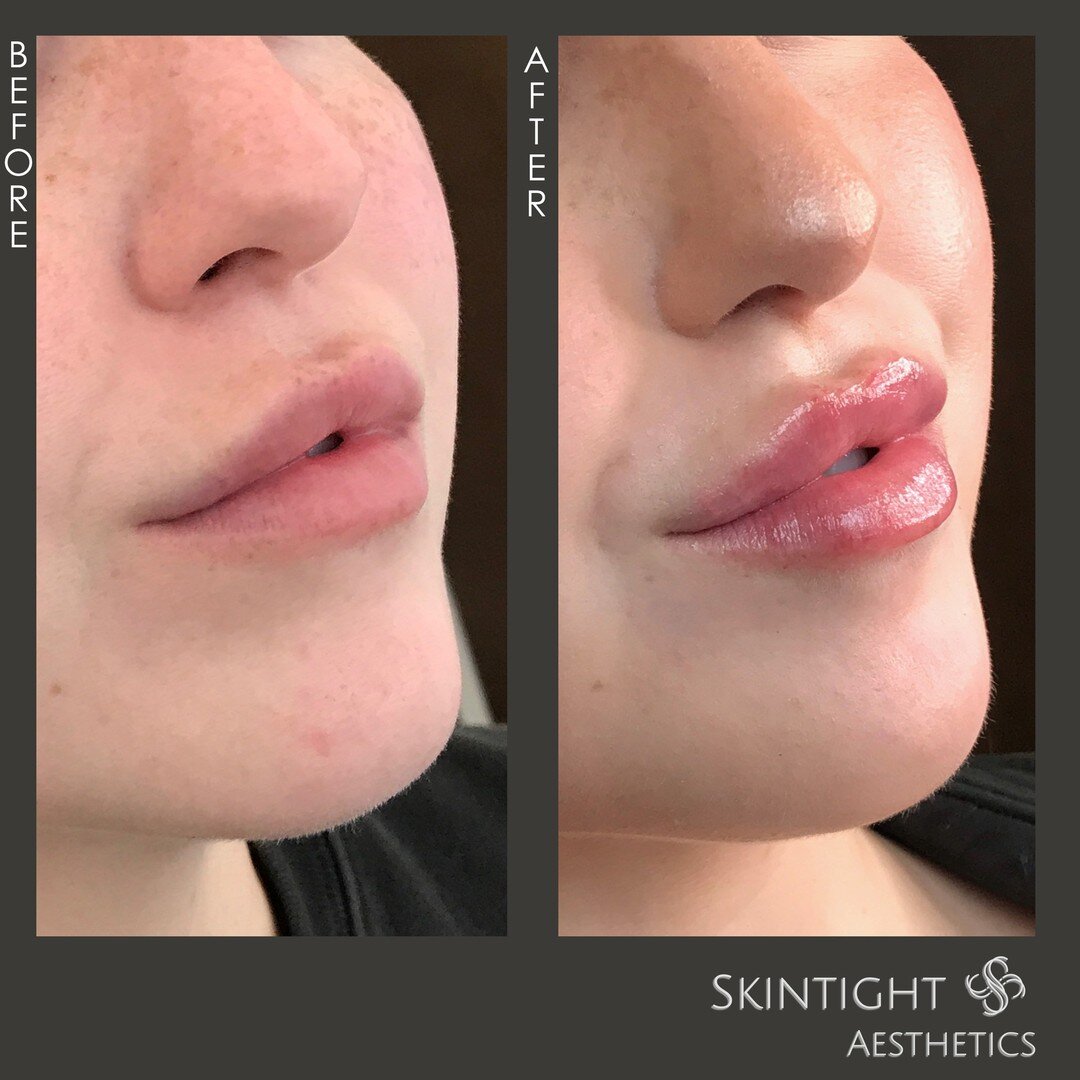 Gorgeous pout by @injector__ash 😘

👄 Treatment: Juvederm Ultra for Lips
💵 Price: $650/Syringe (note: Skintight Aesthetics only charges by the amount each patient uses - price varies based on needs)
🎉 Results: 7-14 days
⏰ Time: 30 Mins
📆 Recovery