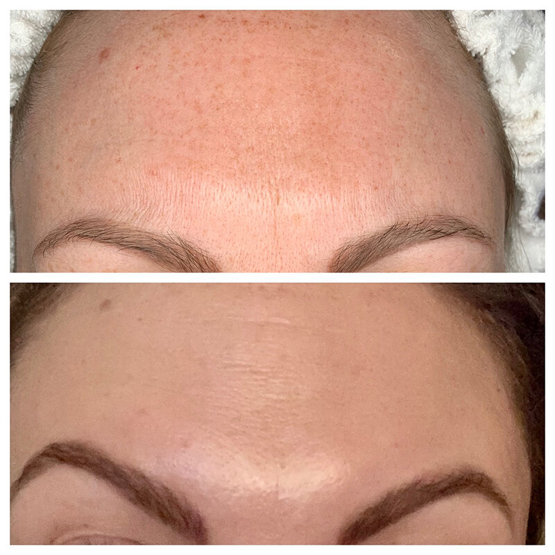 HydraFacial Treatment Before and After Photo