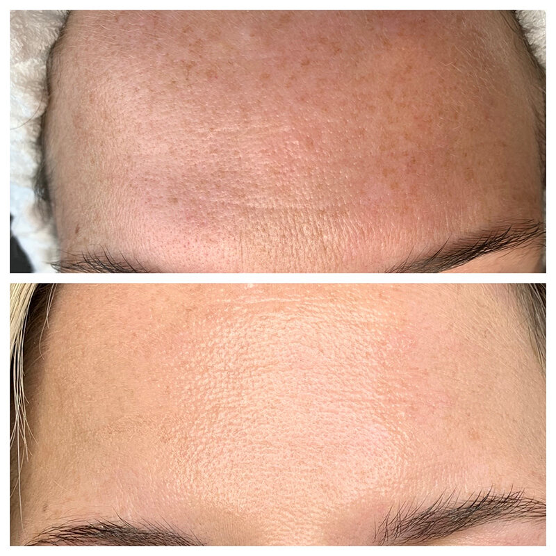 HydraFacial Treatment Before and After Photo