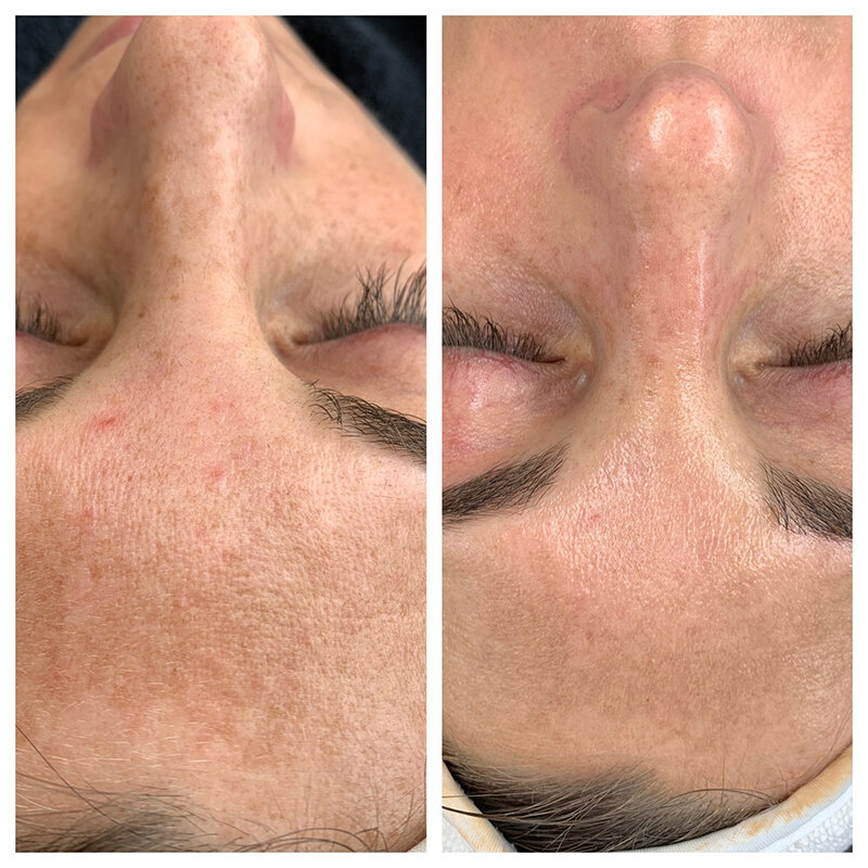 HydraFacial Treatment Before and After Photo