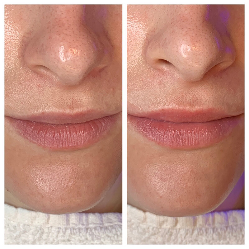 HydraFacial Treatment Before and After Photo