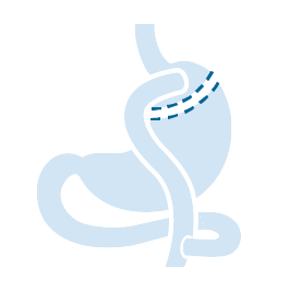 Gastric Bypass.png