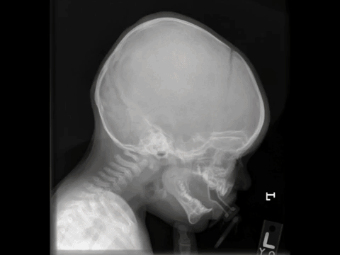 Blunt force head trauma in an infant