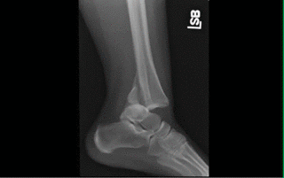 Ankle fracture dislocation