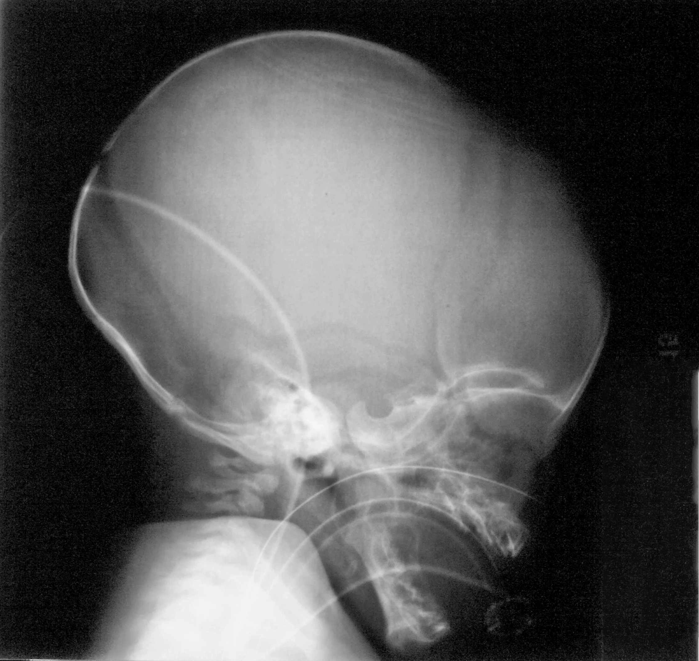 Verdicts in child abuse cases align with Hayes+Associates biomechanics testimony