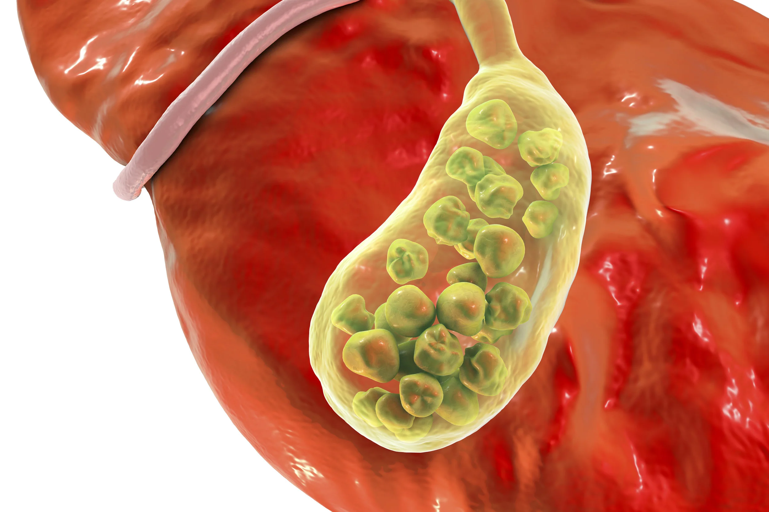 Copy of Appendicitis