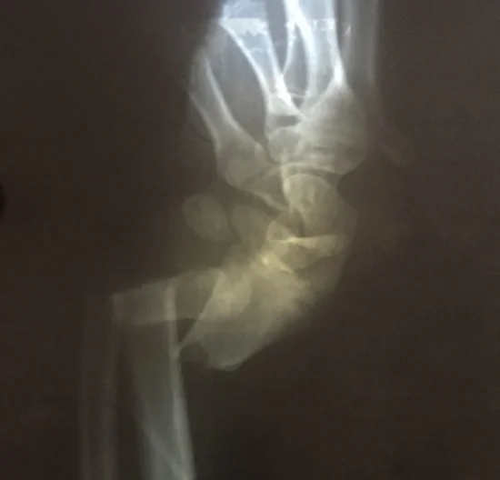 An X-ray of one of Andy's arms, his hand completely separated at the wrist.
