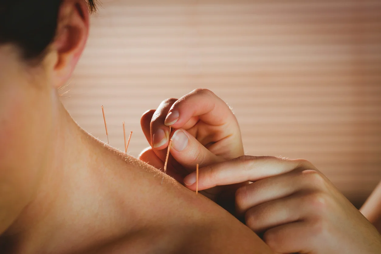 dry-needling.jpg