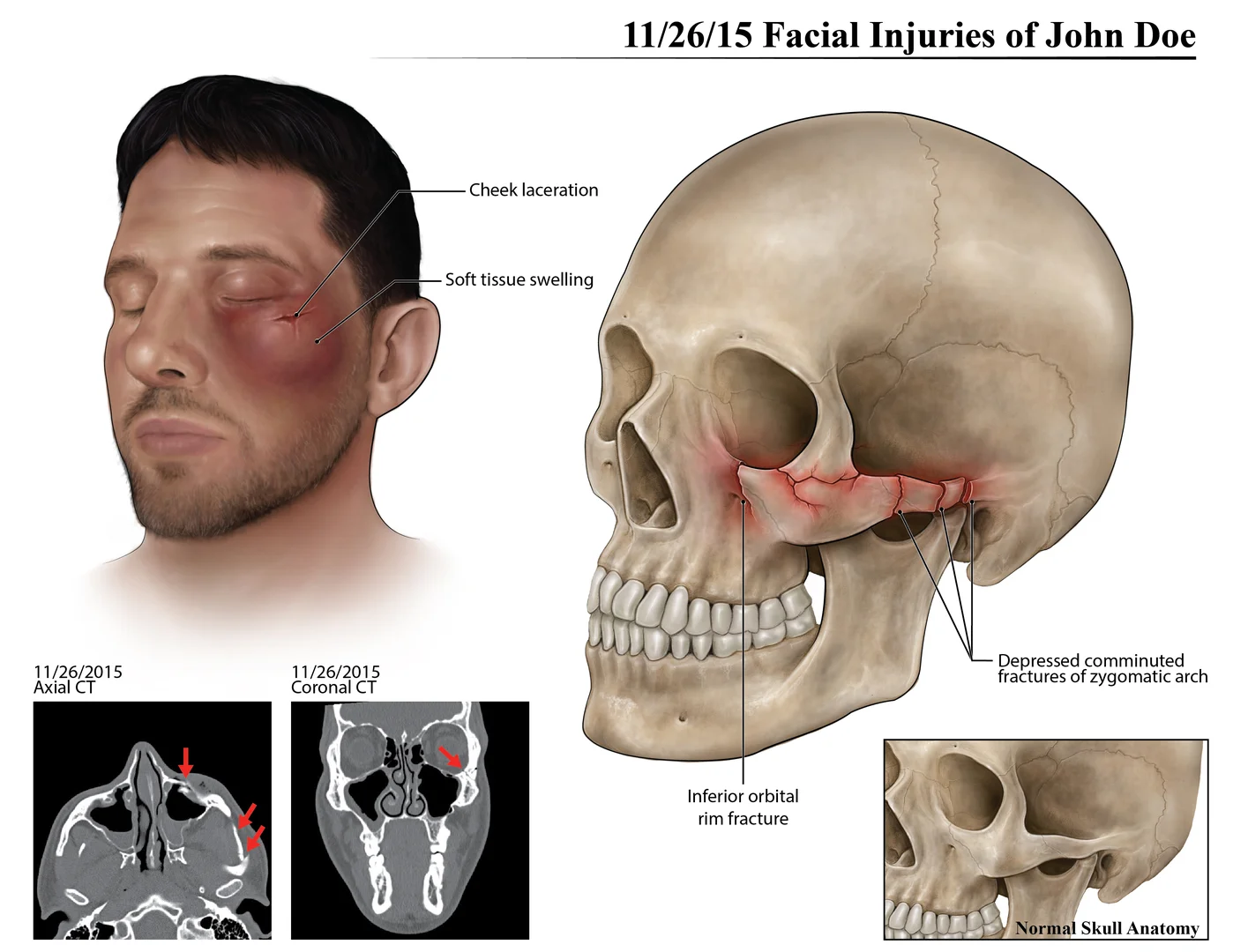11/26/15 Facial Injuries of John Doe