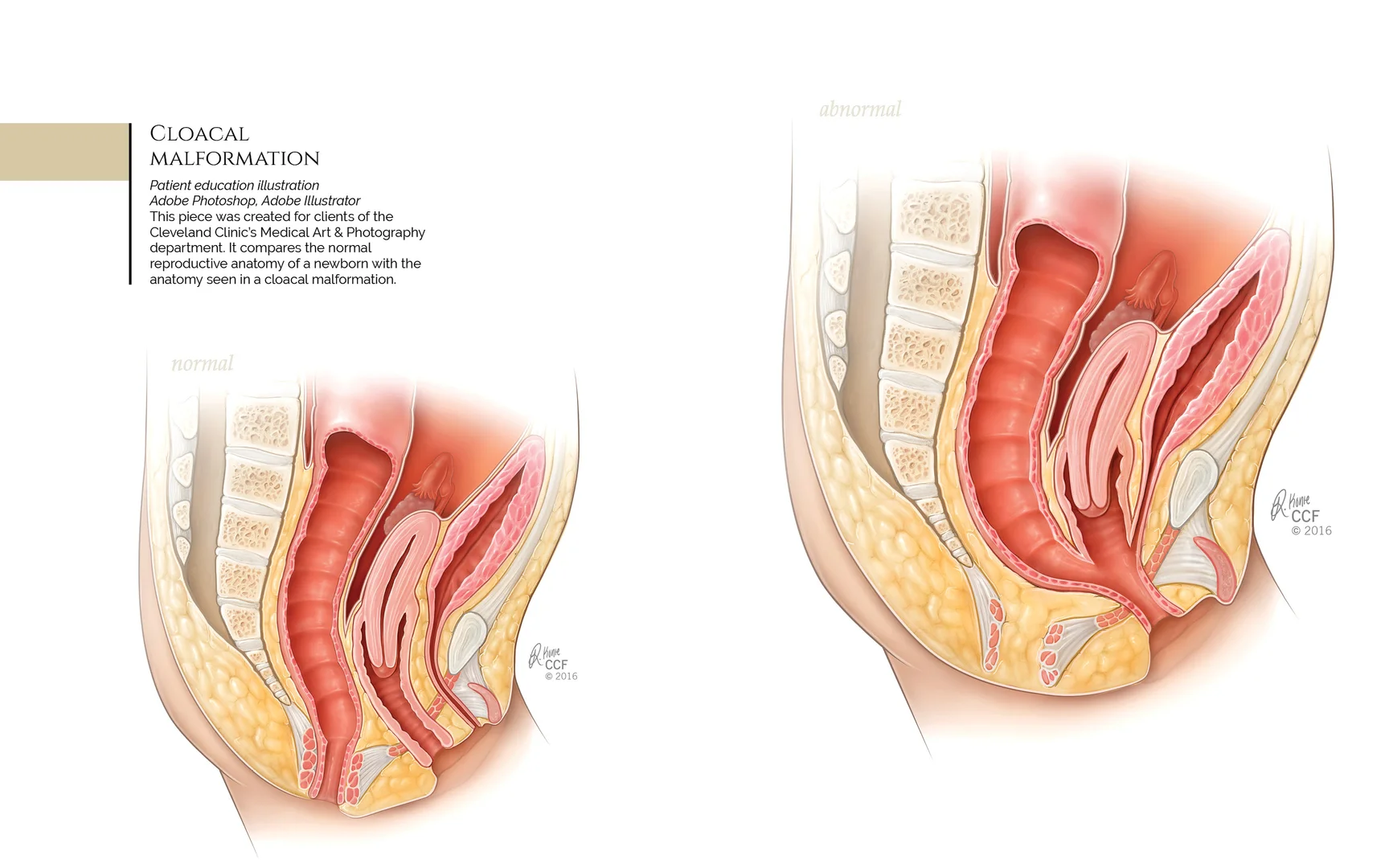Cloacal Malformation
