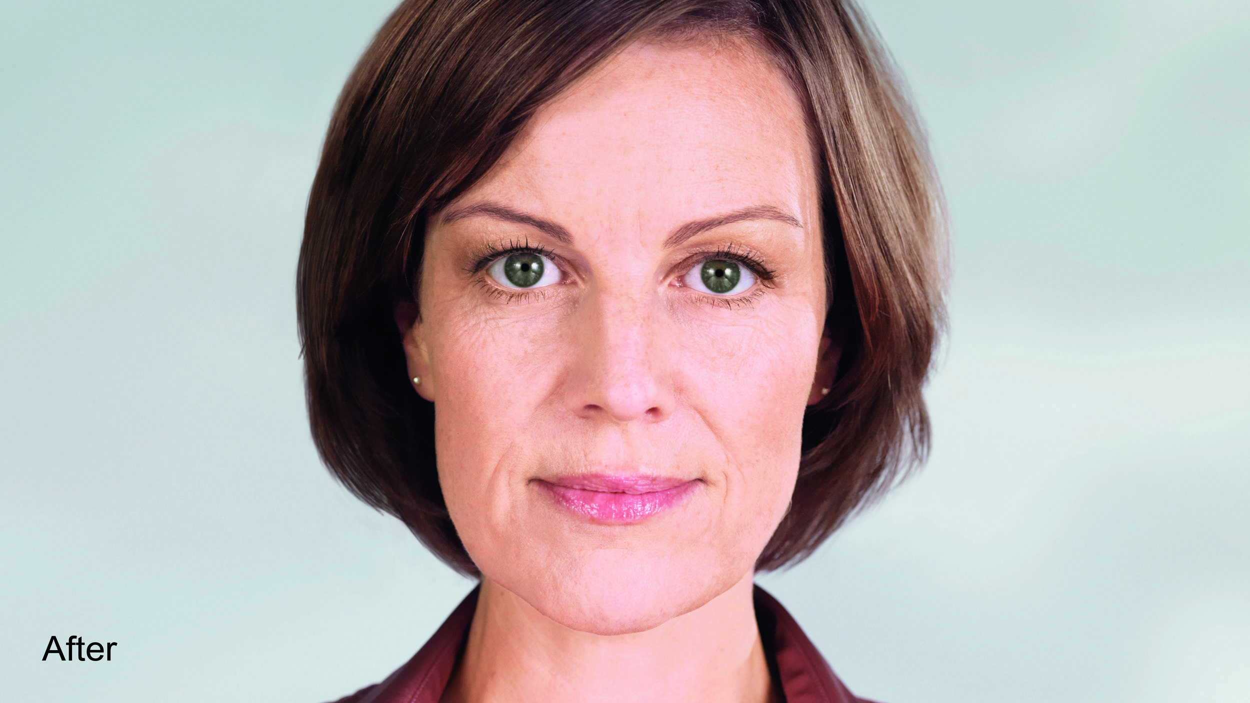 Sculptra injected into NLF & other facial deficiencies