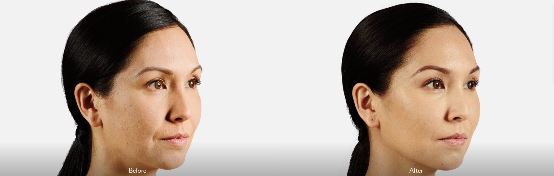 Cheek Augmentation