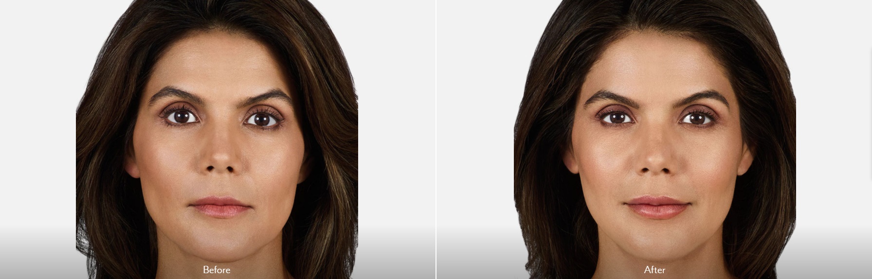 Lip Augmentation