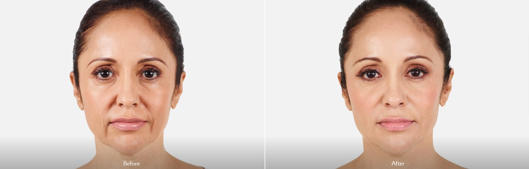 Cheek Augmentation