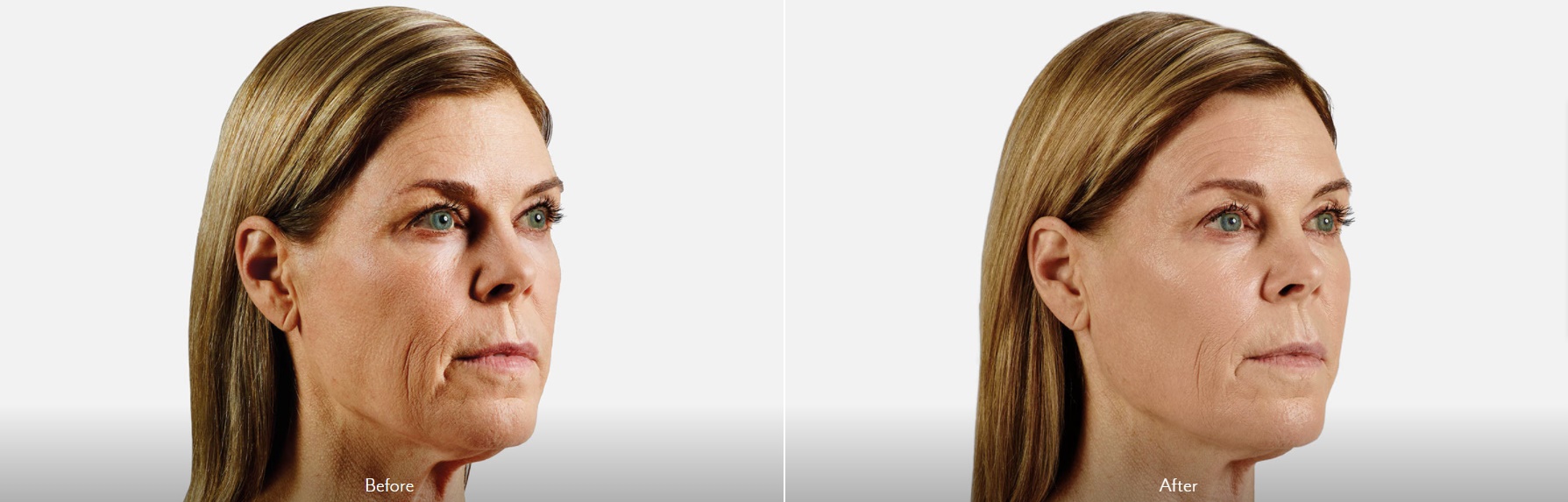 Marionette & Cheek Augmentation