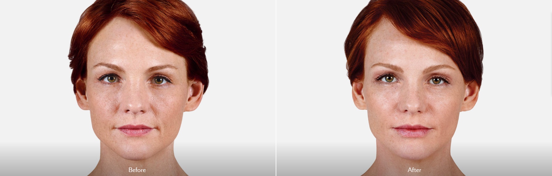 Lip Augmentation