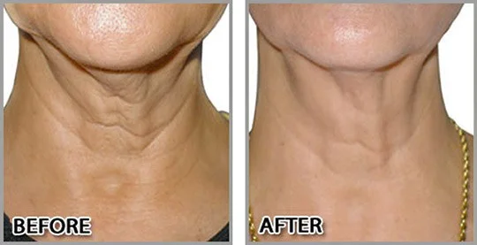 Neck Rejuvenation with PDO Threads