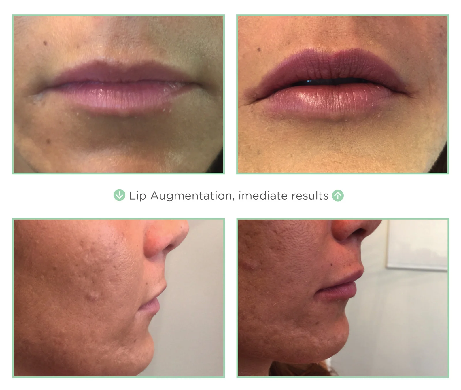 Lip Augmentation with PDO Threads