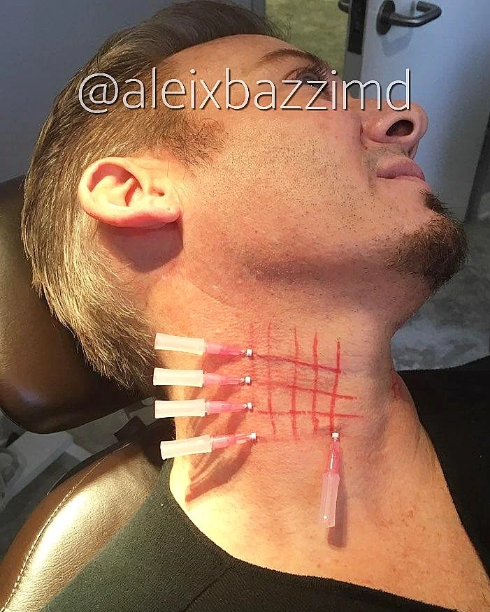 Neck Skin Rejuvenation with PDO