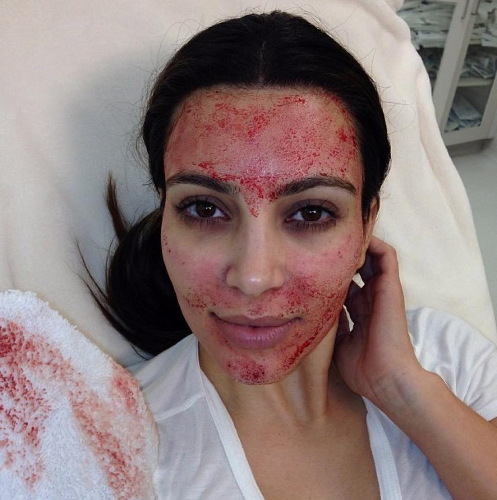 Vampire Facial