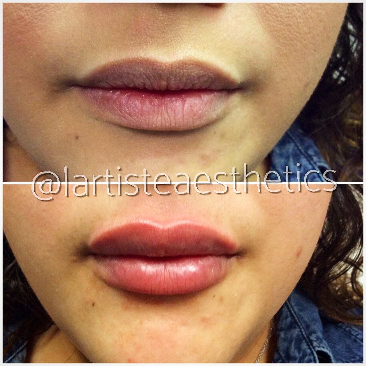 Lip Augmentation