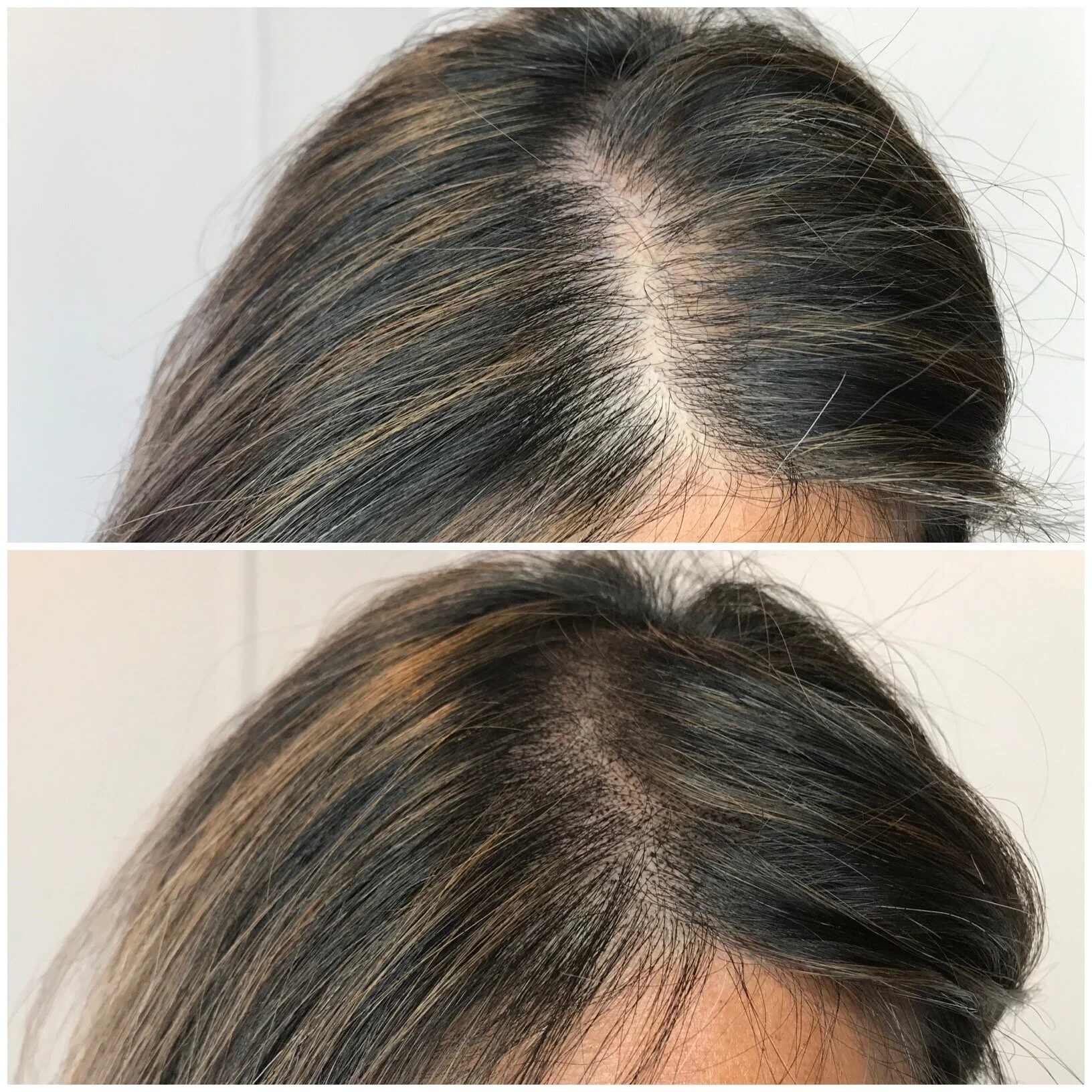 Scalp Micropigmentation by Shannon M