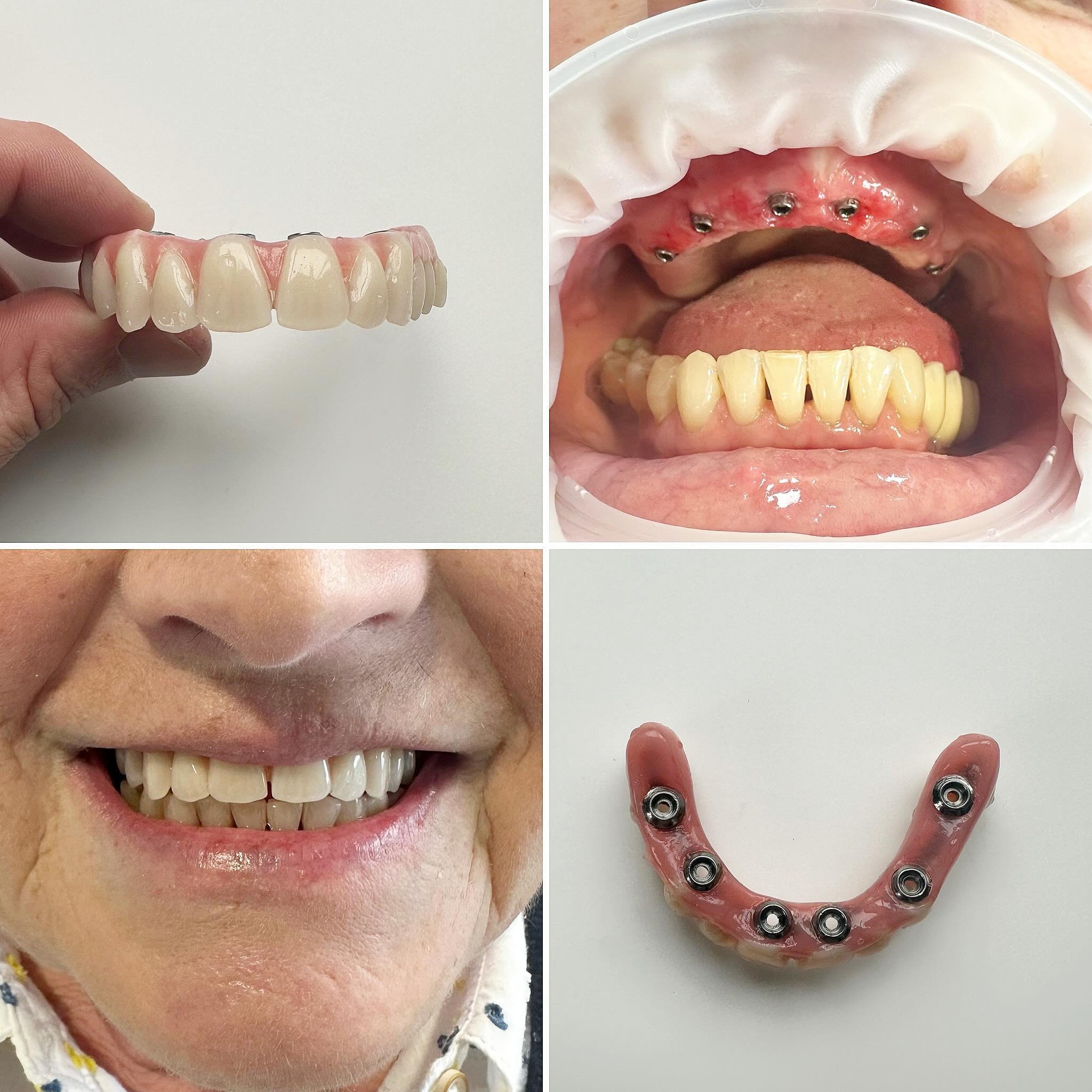 Dental Implants can change lives 👌👍🏻
From not smiling or eating properly, to #confident #natural smiles 😃 

#fullarch Friday 😆 hate to use the pun
#implantology @onebyonedental ♾️