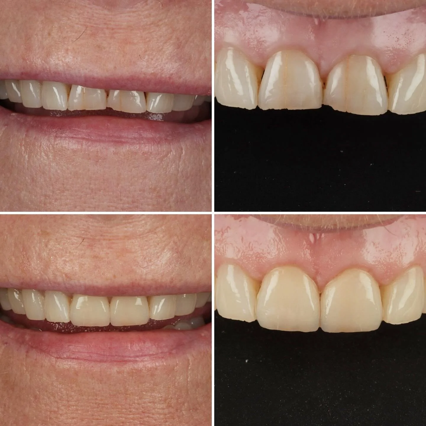 Beautiful natural transformative result from @drdanielgillen to send everyone smiling into the weekend @onebyonedental ♾️ 
👌👍🏻
.
#natural #smiles