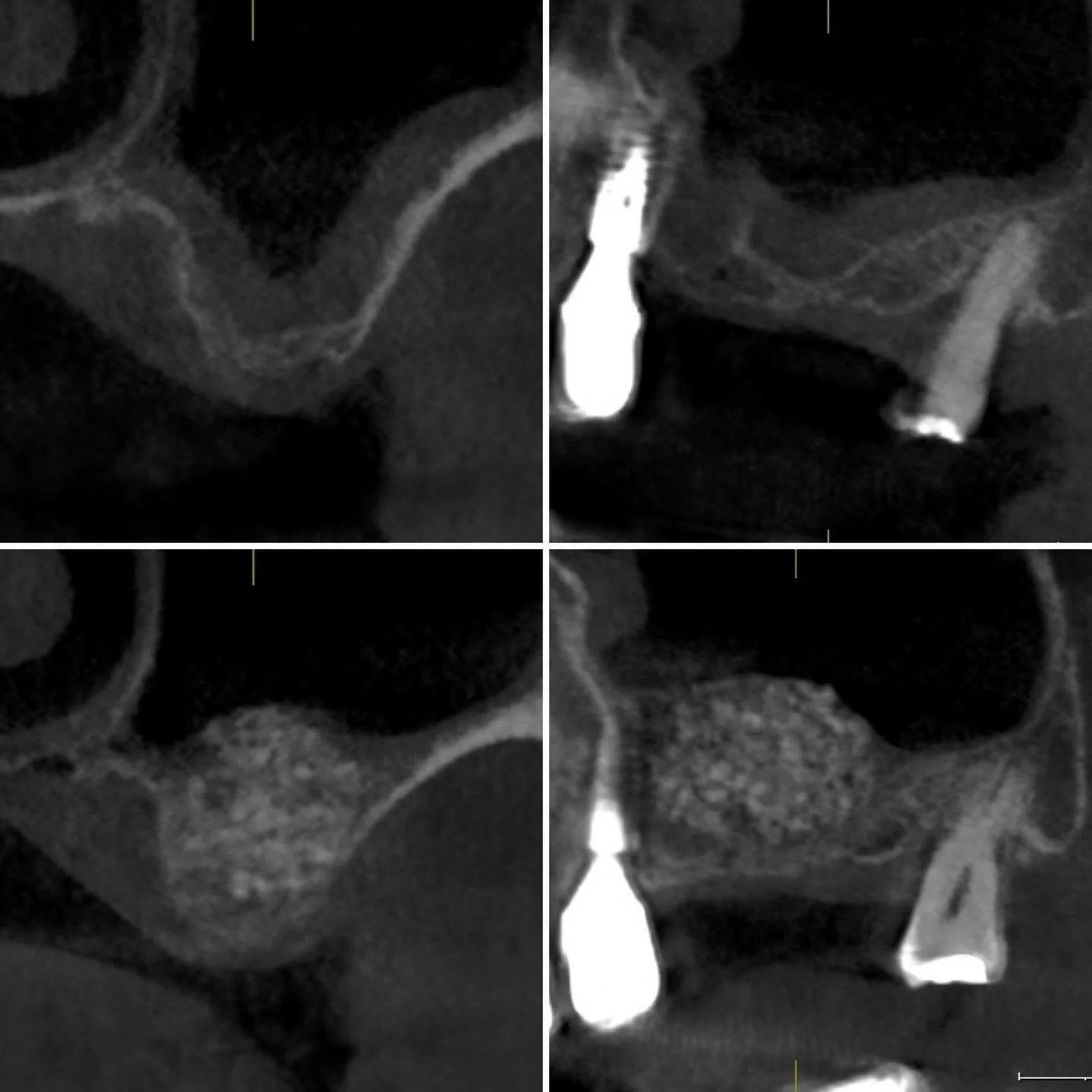 Hands up if you love the nerdy 🤓 content ✋🏻
Chris does 🙄😆
#cbct showing before and after of posterior maxilla bone volume following Lateral Sinus Lift via a Caldwell Luc approach 
Guided bone regeneration utilising @geistlichuk and Platelet Rich 