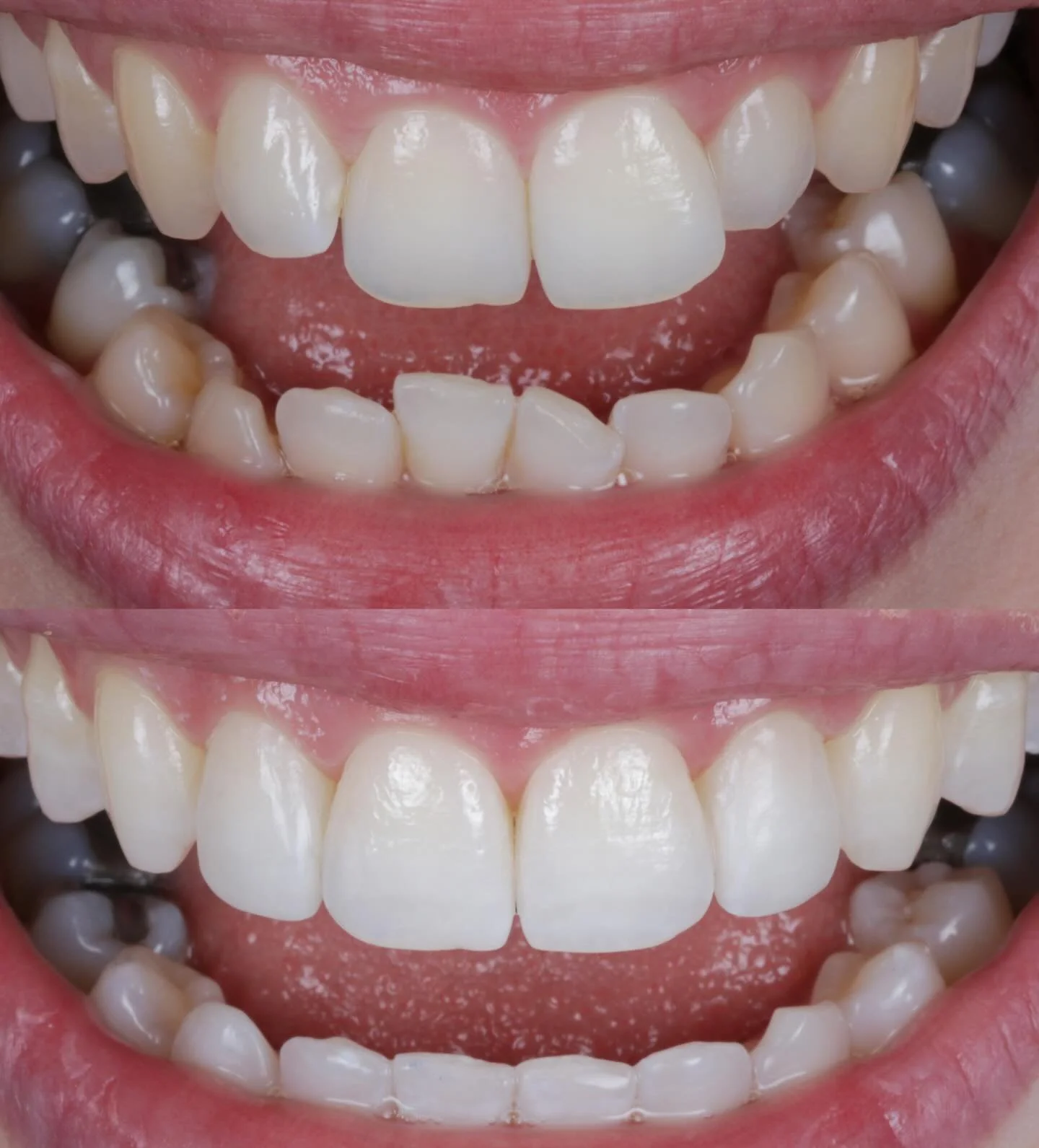✨ Smile Goal Achieved ✨ 
This patient&rsquo;s journey shows the power of combining treatments for the perfect finish with 👨🏻&zwj;⚕️ @michaelcrilly_dental @onebyonedental ♾️ 📍 

@invisalign_uk gently straightened and aligned their teeth over time, 