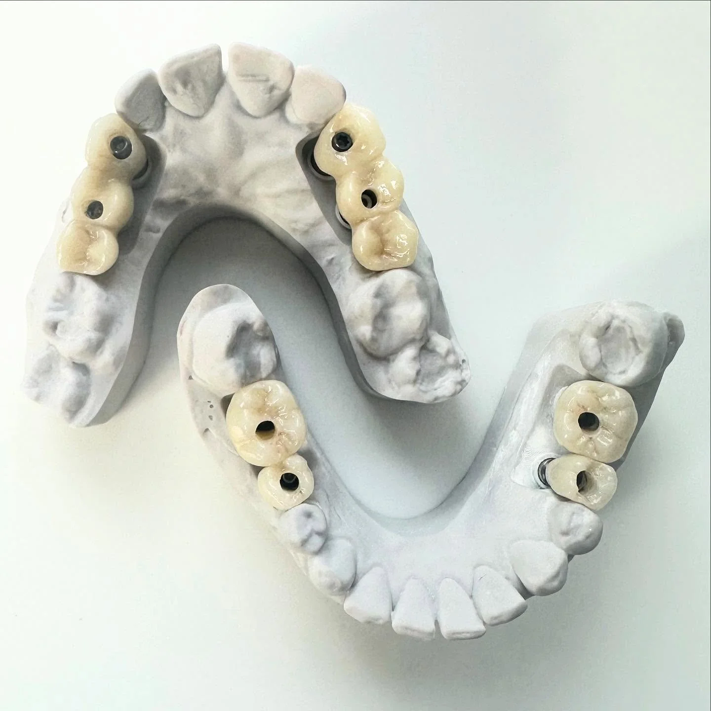 This ☝🏻
Helping this lovely patient Smile, Eat and Talk with confidence again 👌👍🏻
Implant retained bridges replacing the missing maxillary canines and premolars, and implant crowns to replace missing mandibular molars and second premolars 
Bilate