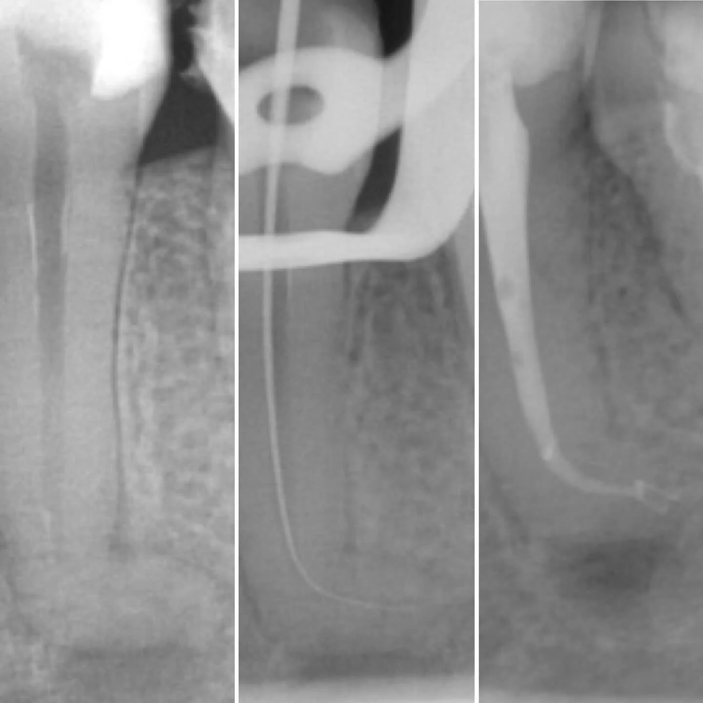 We haven’t posted a radiograph in a while β’οΈ 
Root treatment on a LL5 with dilaceration πͺ
Challenging but very rewarding @onebyonedental βΎοΈ 
‘It’s not about the white lines’ resonates in our ears’
but it helps when it l