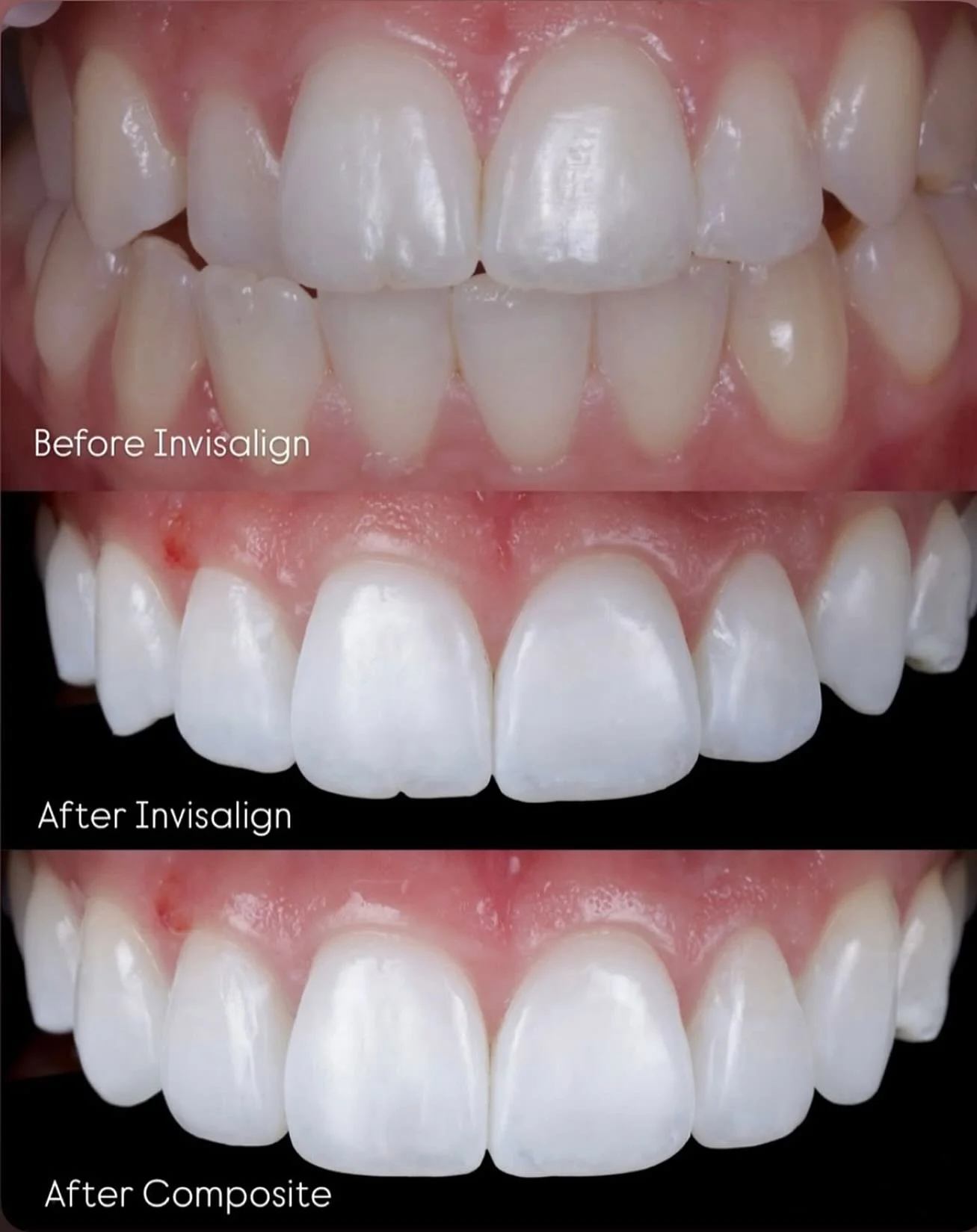 Beautiful transformation from @michaelcrilly_dental π¨π»‍βοΈ Behind the bite → Straight and white → Finished just right @onebyonedental βΎοΈ 
This patient came to us unhappy with the position of her teeth, in particular her upper lateral i