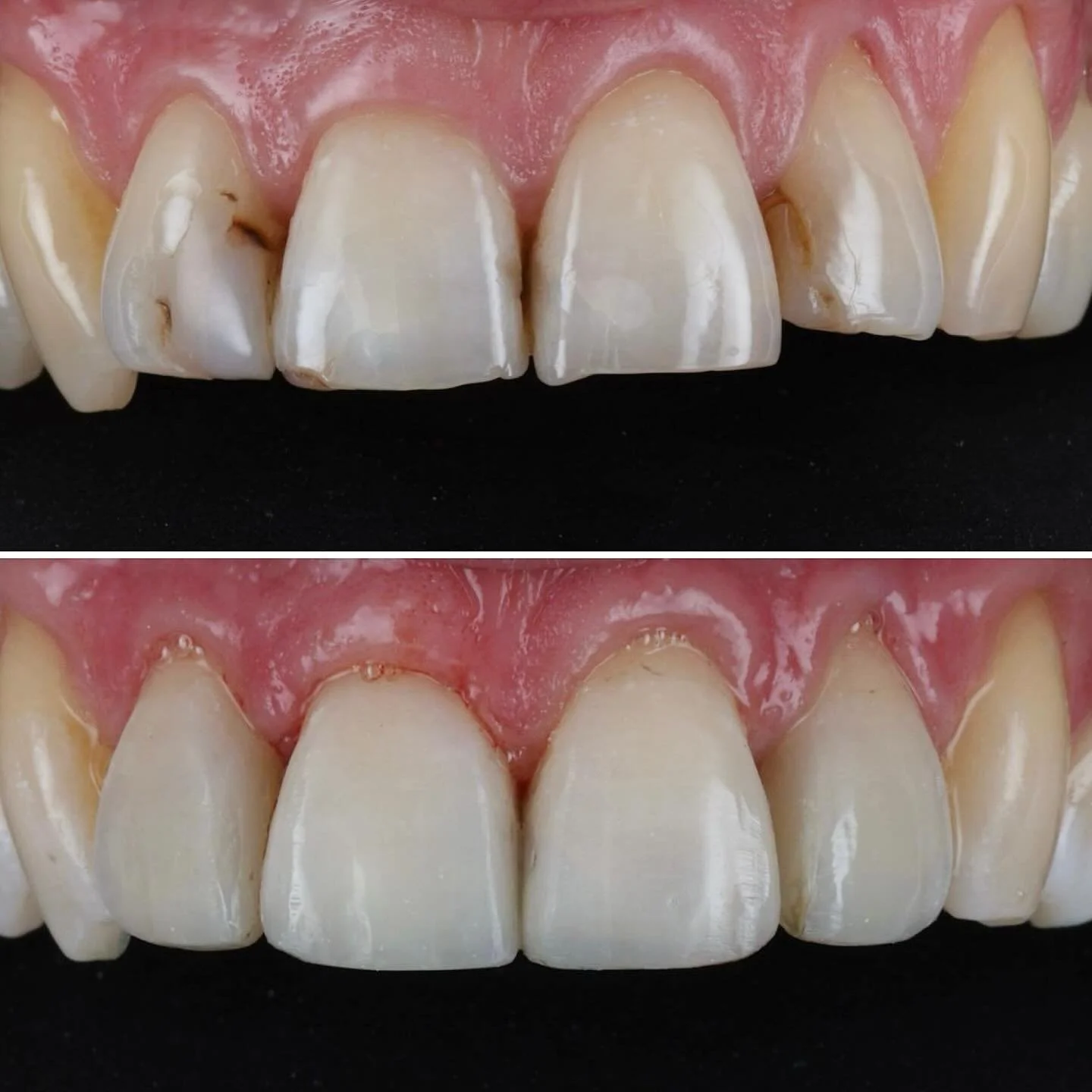 A beautiful result by @drdanielgillen 👨🏻&zwj;⚕️ expertly restoring these broken and stained incisors. The natural shape, color, and harmony are back &mdash; and so is the patient&rsquo;s confidence 👌👍🏻