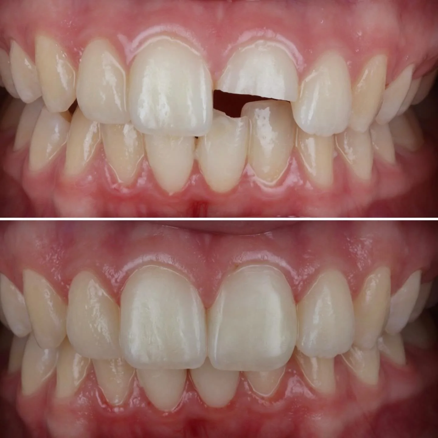 What an incredible result by @drdanielgillen 👨🏻&zwj;⚕️ 
Teenager, sport related trauma UL1 - significant ED# just avoiding pulpal exposure - flick across 👉🏻
It was wonderful watching Daniel taking such care and attention to restore her beautiful 