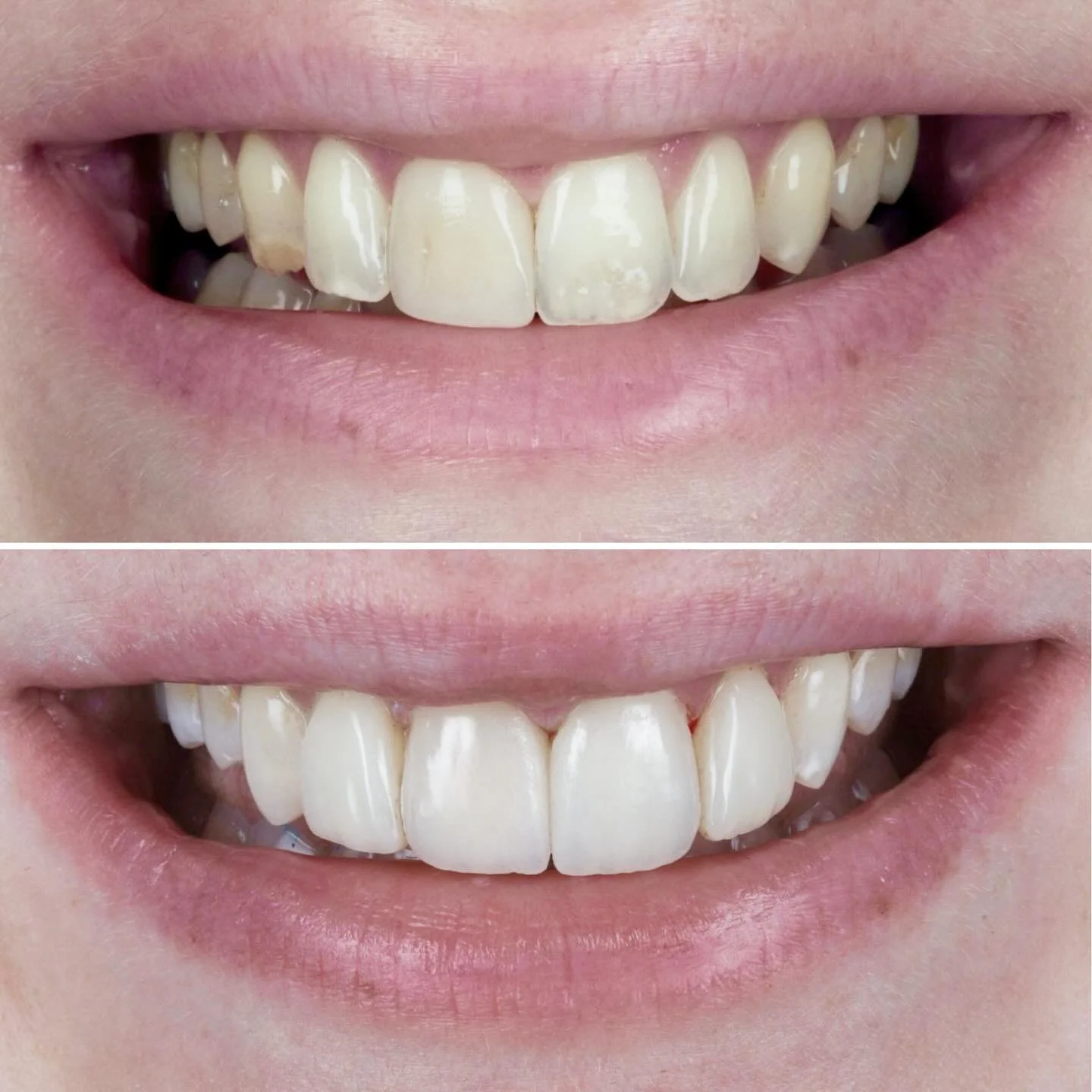 👌👍🏻 @drdanielgillen 👨🏻&zwj;⚕️ enhancing this beautiful natural smile @onebyonedental ♾️ 
Porcelain veneers and composite bonding improving colour and shape - all in time for Christmas 🎄