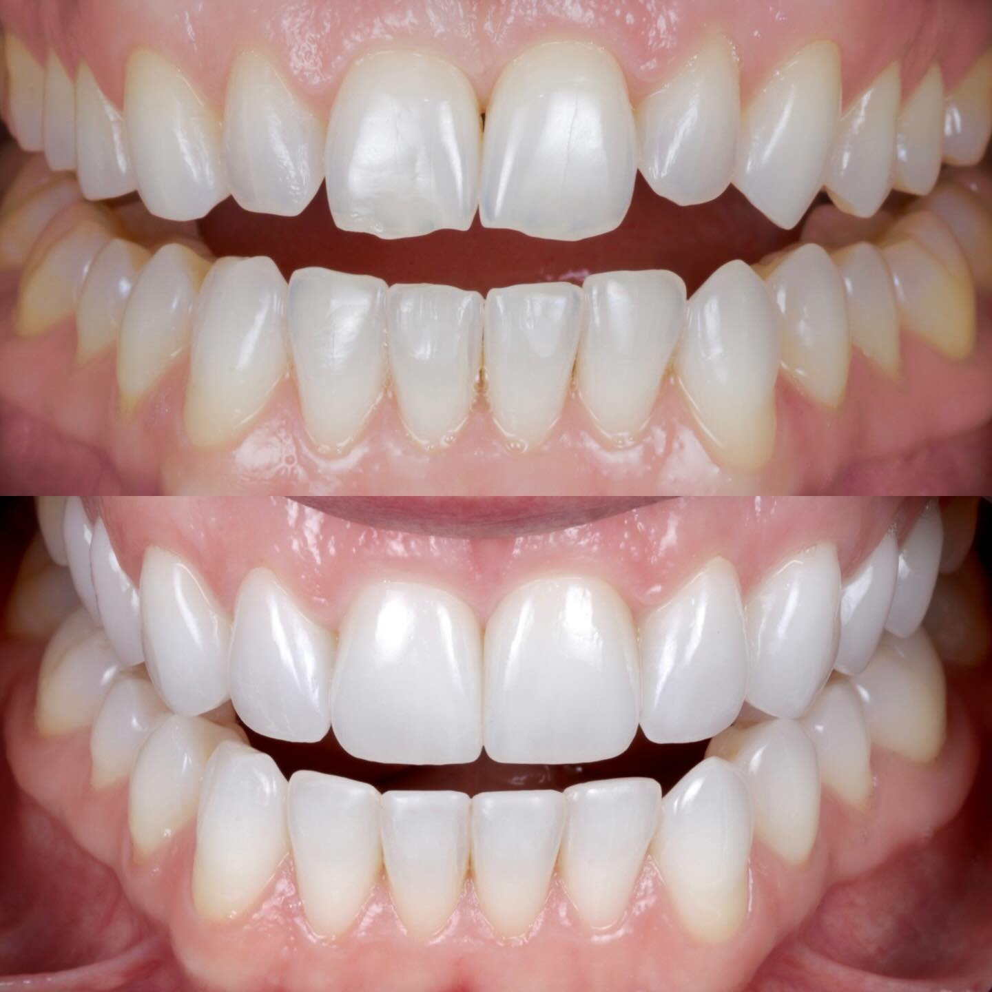 Exceptional result from @michaelcrilly_dental 👨🏻&zwj;⚕️ @onebyonedental ♾️ Stranmillis 📍 
Upper 10 Feldspathic Veneers
Lower composite bonding
One Beautiful Smile 👌👍🏻
.
.
.
.
.
.
#cosmeticdentist #belfast #dentistbelfast 
#cosmeticdentistry 
#d
