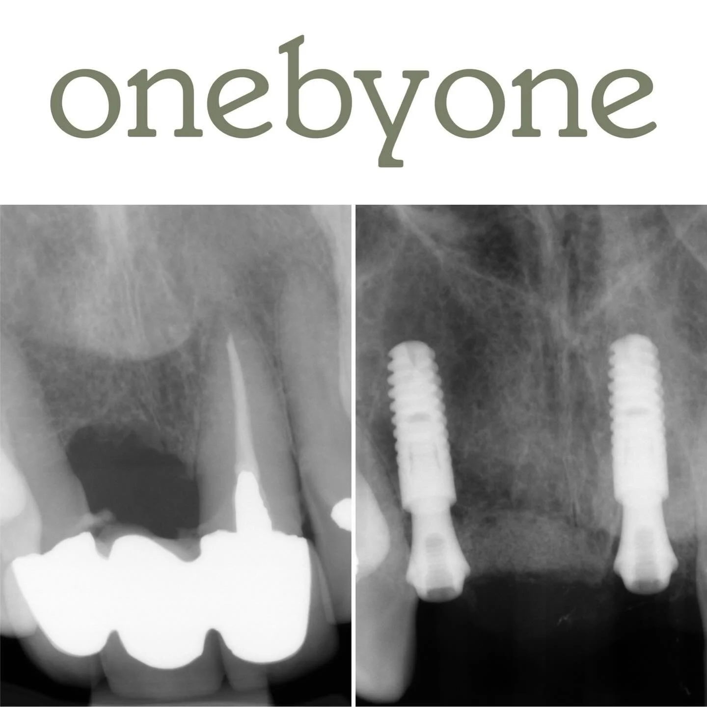 We love it when a plan comes together 👌
Immediate Implant Placement with simultaneous vertical and horizontal bone augmentation to enhance the pontic emergence @onebyonedental ♾️ 
.
Patient referred regarding failed 3 unit bridge UL1-UR2
Assessment 