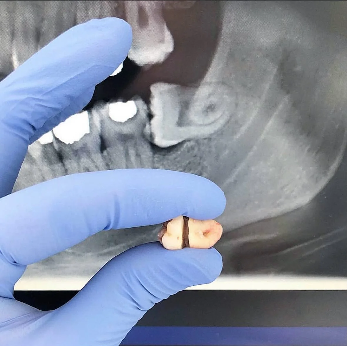 Interesting or not? 🤔 
How do we remove impacted #wisdomteeth 
Well, like this 😝
@onebyonedental ♾️ 
.
.
.
#wisdomteethremoval #oralsurgery #radiology