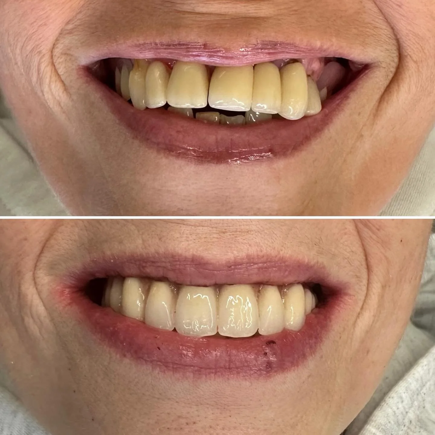 Double Full Arch Monday 👍🏻 @onebyonedental ♾️ 
Clearance and immediate load Upper and lower @dentsplysirona.uk Implant retained temporaries 👌
Now for the healing period before we move to definitives 👌👍🏻 
.
.
.

#allon4 #allonx #implantology