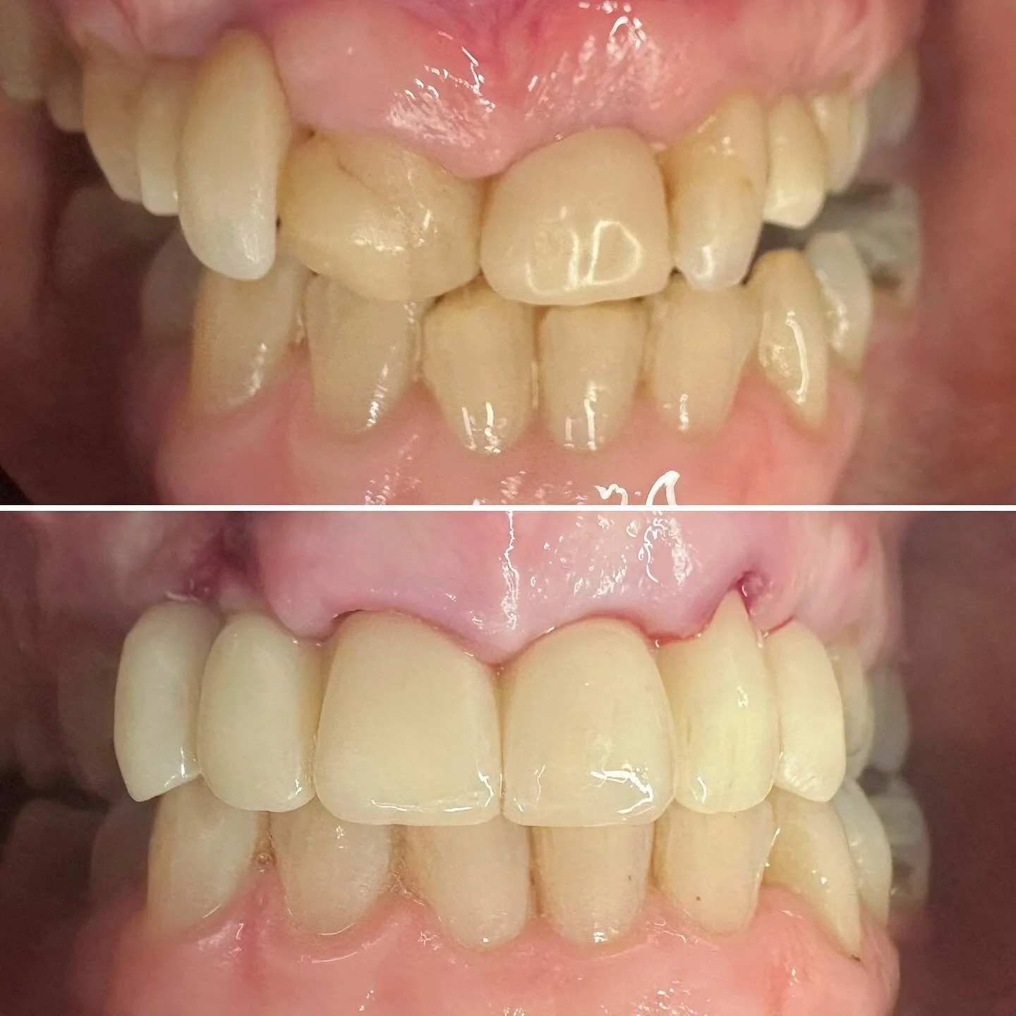 Implant retained temporary 3-3 👌👍🏻
Immediate X3 implants 13 11 13 @dentsplysirona.uk 
Socket preservations GTO @osteobiolbytecnoss 
Removal of buried root under 12 and modified CTG
Temporary prosthesis to allow healing @hive_dental_laboratory 🐝 
