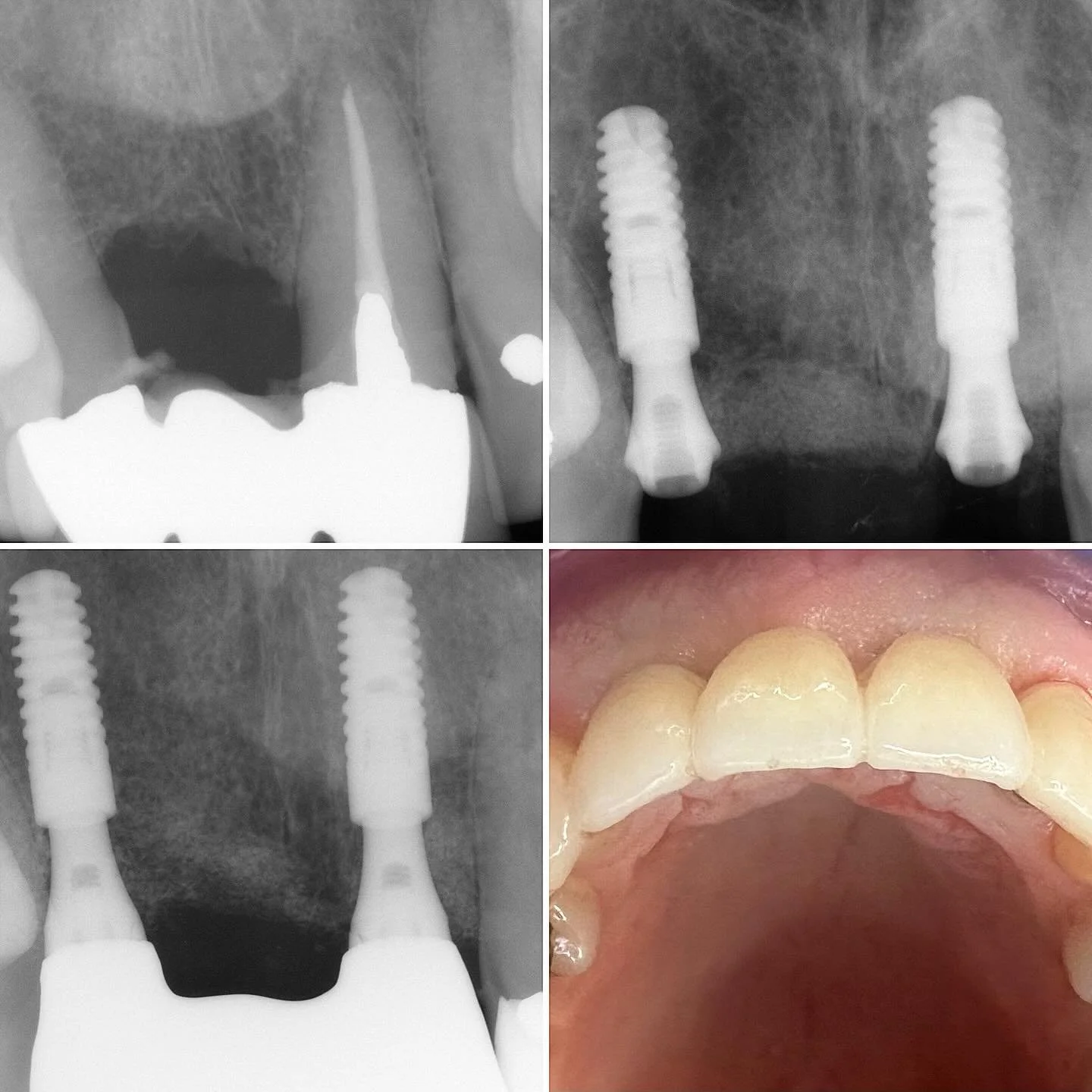 Form and function restored @onebyonedental ♾️ 
Patient referred regarding:
Replacement of failed UL1-UR2 bridge and Veneer UL2
Immediate Implants UL1 UR2 @dentsplysirona.uk 🔩
Vertical and horizontal GBR @geistlichuk 🦴 
Prosthetics @hive_dental_labo