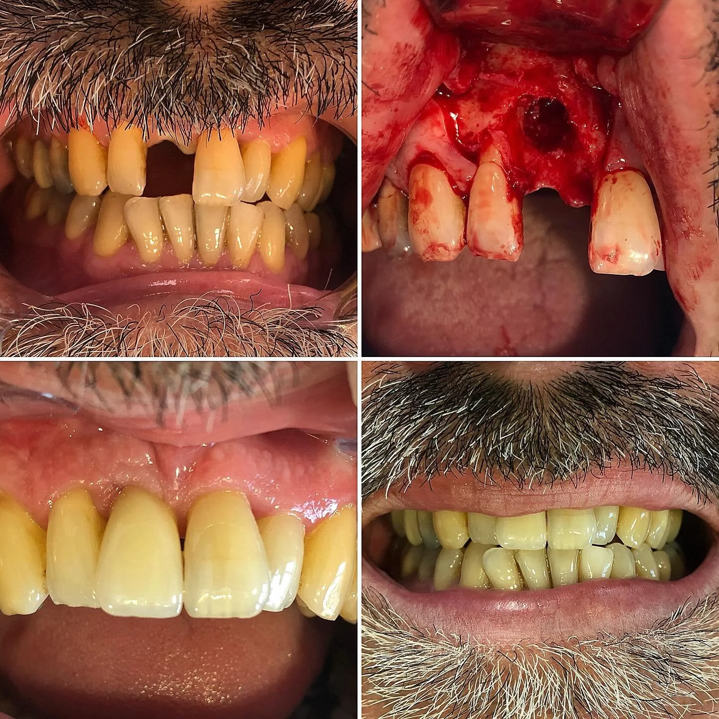 Don&rsquo;t leave root fractured teeth 😳
Patient referred with root fractured UR1 resulting in gross bone loss
Thankfully @onebyonedental ♾️ we were able to replace it with @dentsplysirona.uk #ankylos Implant and @geistlichuk Guided Bone Regeneratio