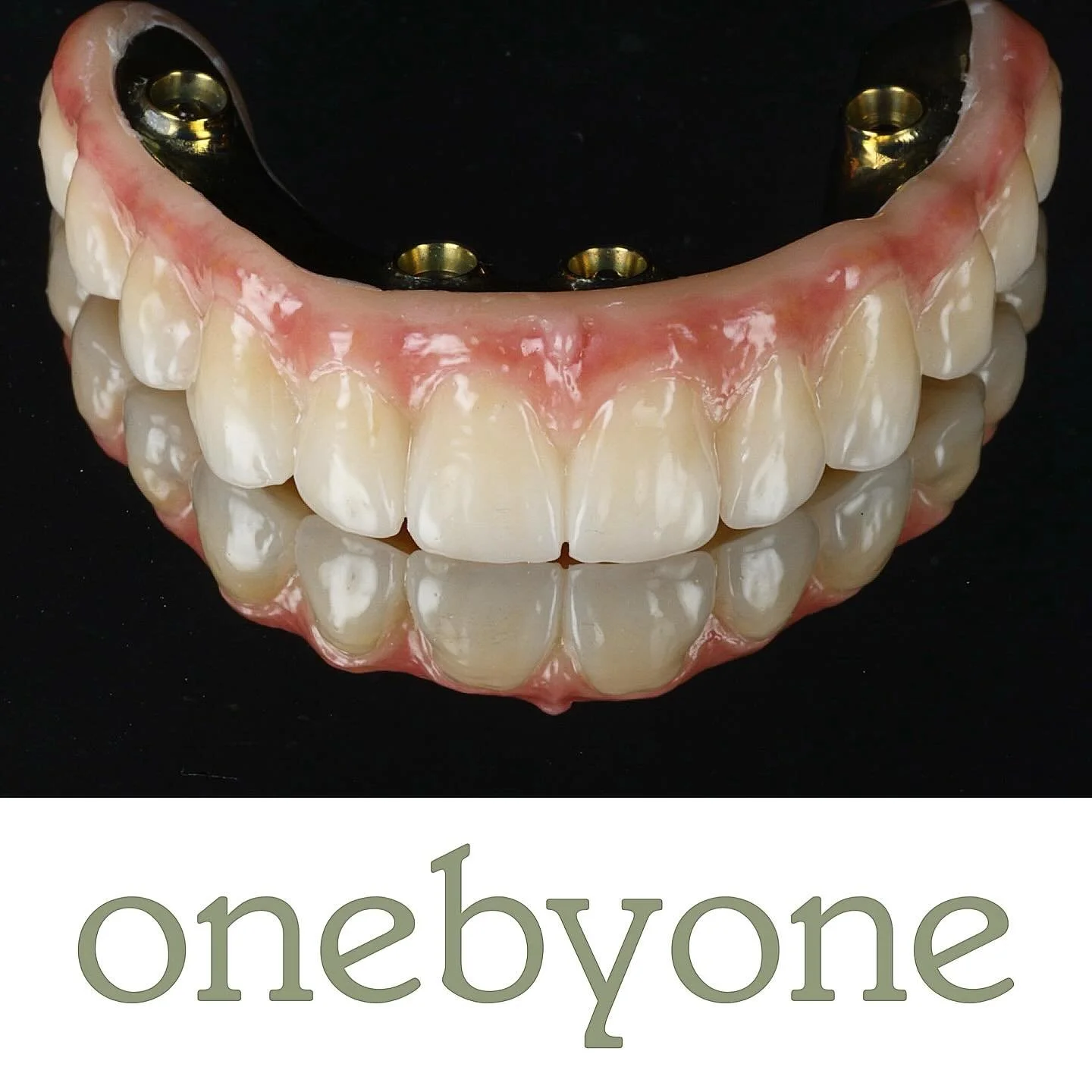Beautiful full arch fit ready for tomorrow @onebyonedental ♾️ 
Credit to @drdanielgillen 🧑🏻&zwj;⚕️ for the photo, we all know Chris just uses his phone 🫣
Surgeon - Prosthodontist - Technician in symbiosis 👌👍🏻
Digital dentistry delivering beauti
