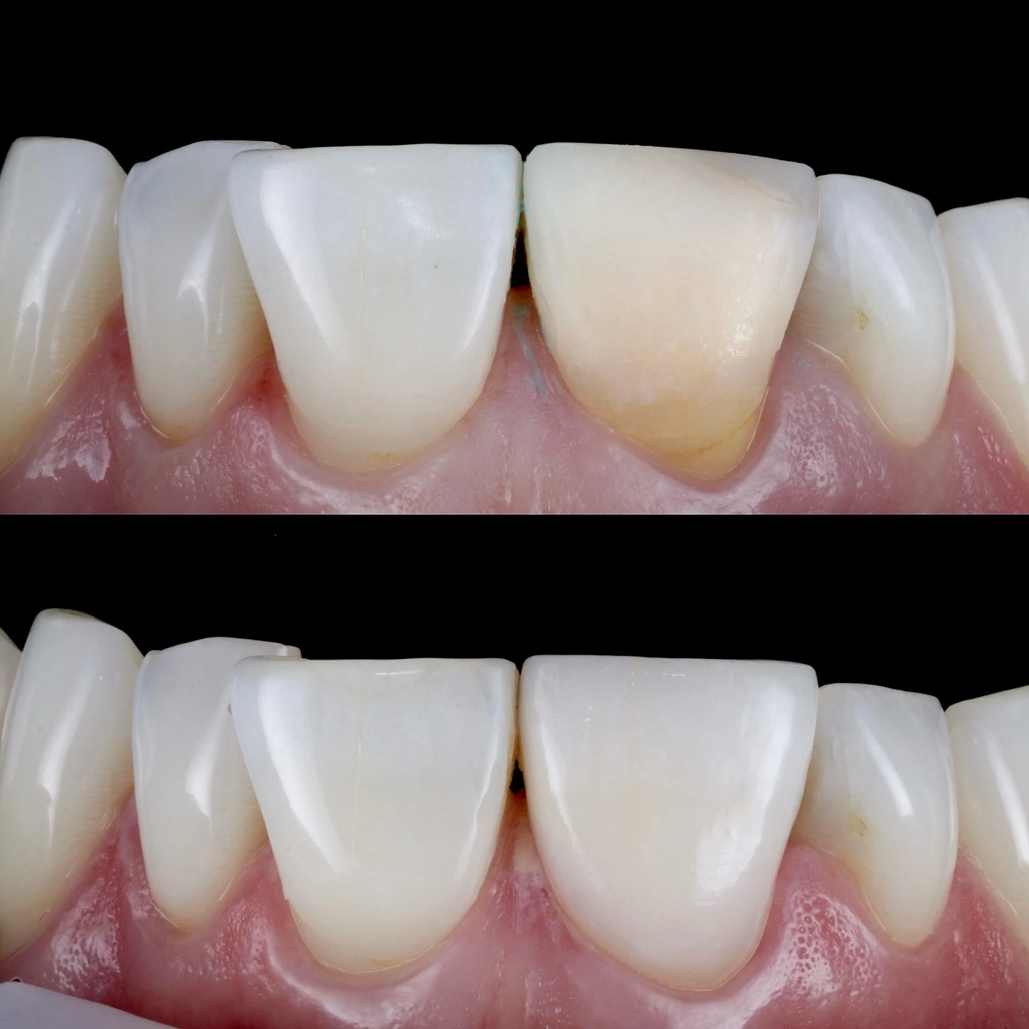 Single central veneer @michaelcrilly_dental 👨🏻&zwj;⚕️ 
Beautiful Natural Seamless
The goal isn&rsquo;t for anyone to notice the veneer
Simply to improve a wonderful smile 👌👍🏻
@onebyonedental ♾️