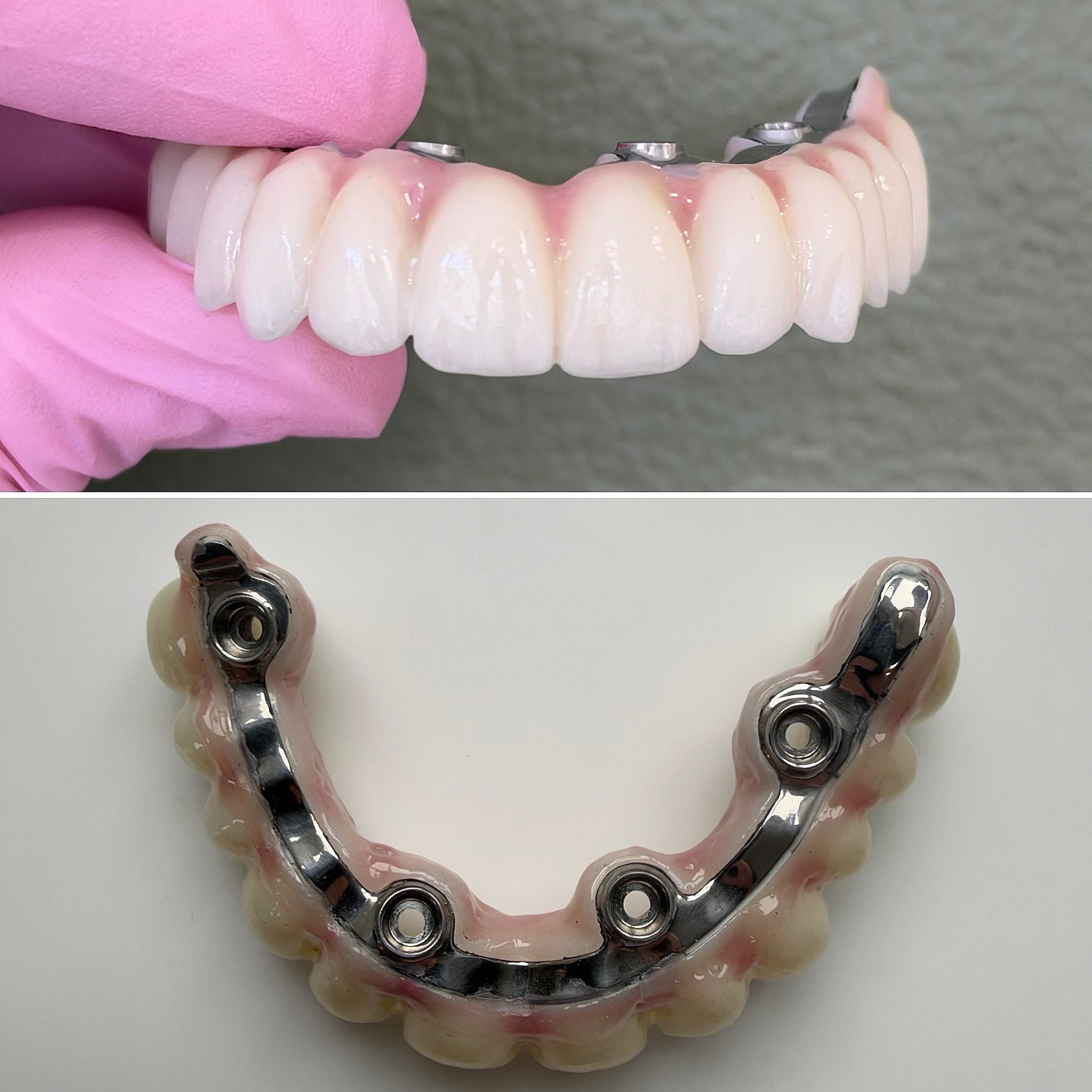Full arch fit to make you and us smile on a Friday 
@onebyonedental ♾️ 
Implants to replace missing top teeth 👌👍🏻
#dentaltechnician and #dentist in symbiosis 🙌