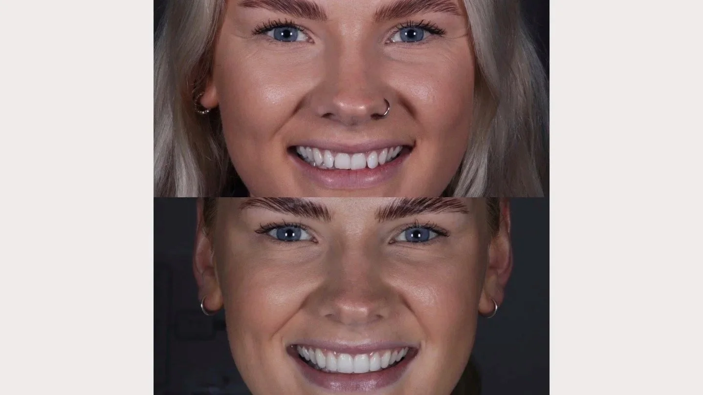 Invisalign Packages Pic2.jpg