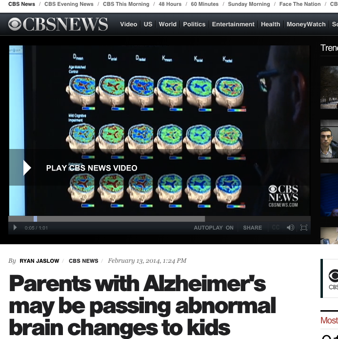 CBS: Parents with Alzheimer's may be passing abnormal brain changes to kids