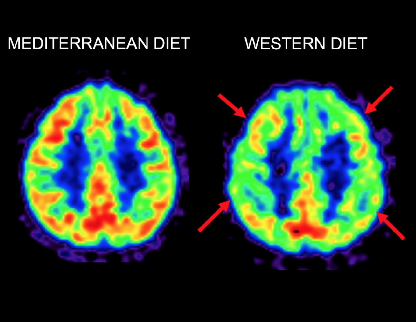 Mediterranean Diet May Protect Against Alzheimer's